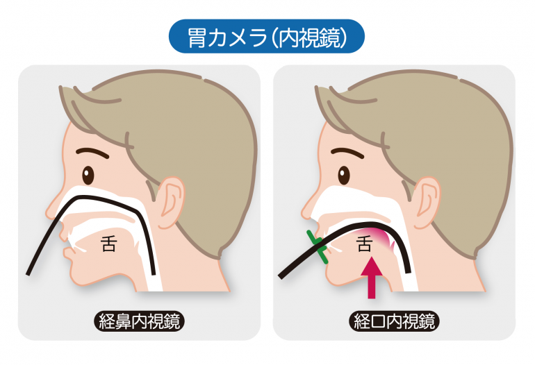 経口検査・経鼻検査を患者様にお選びいただいています